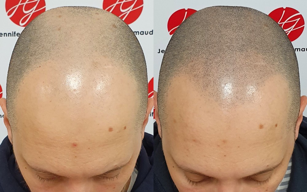 Dermopigmentation capillaire effet crâne rasé sur un homme