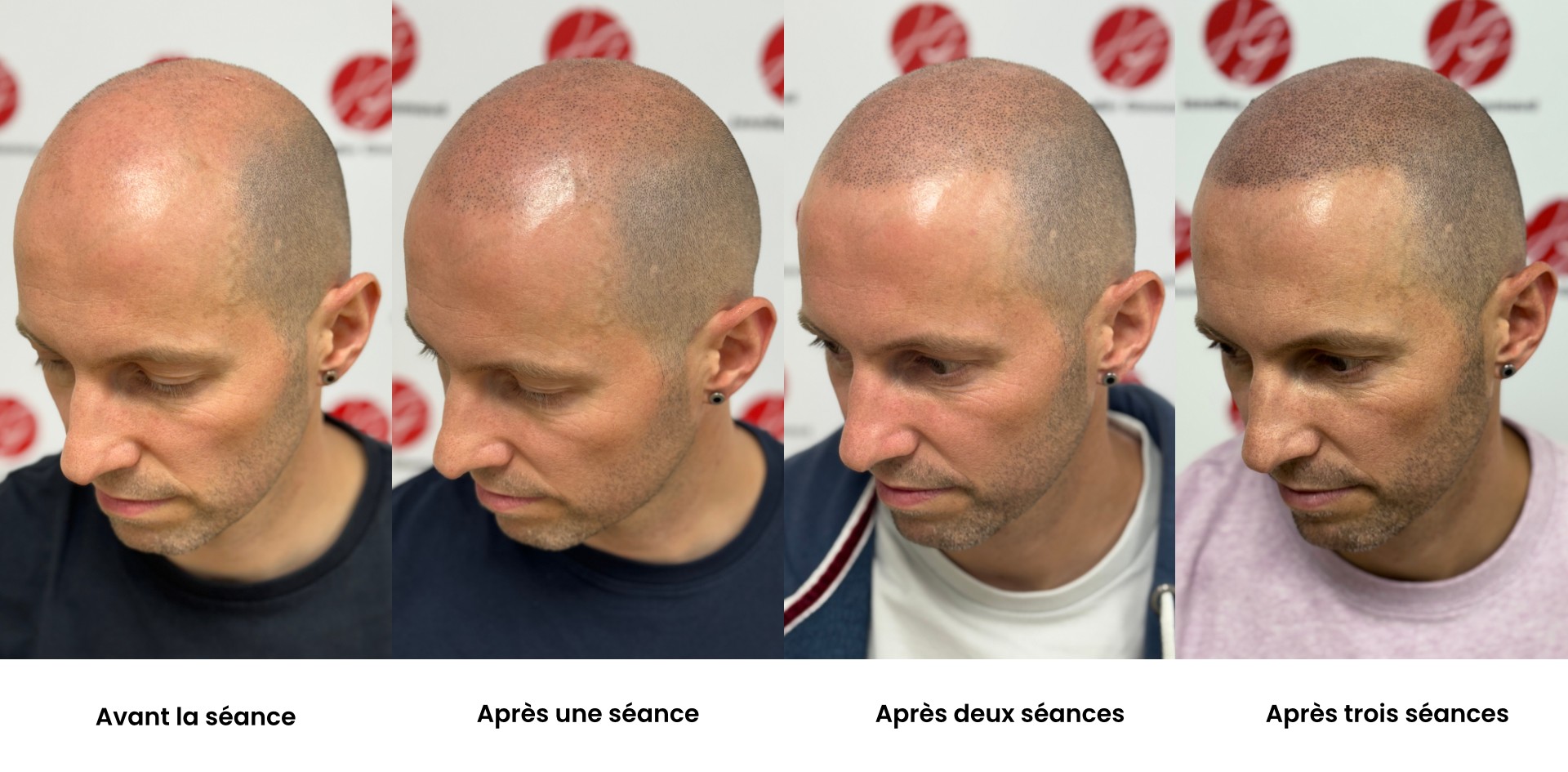 Évolution des résultats d'une tricopigmentation après 3 séances sur homme