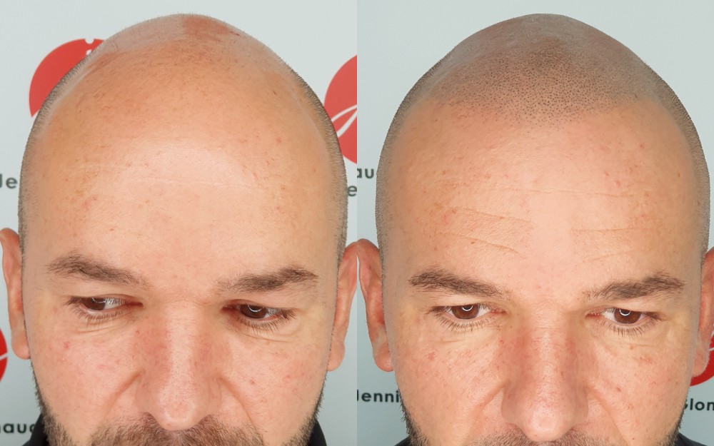 Tricopigmentation abaissement ligne frontale homme avant après - Centre Jennifer Glomaud