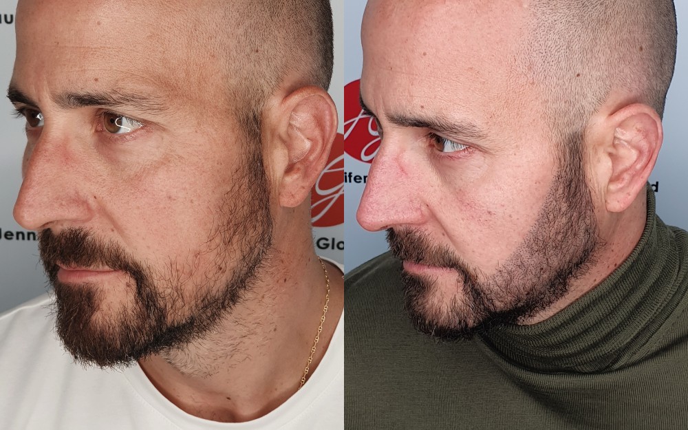 Tricopigmentation homme densification de la barbe avant / après
