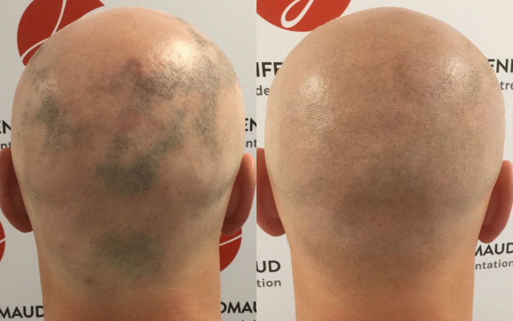 Tricopigmentation pour camoufler des pelades - homme - Centre Jennifer Glomaud