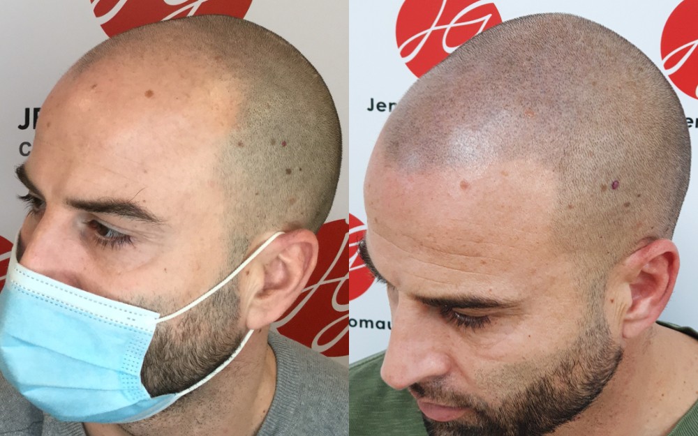 Tricopigmentation homme abaissement de la ligne frontale et des golfes avant / après