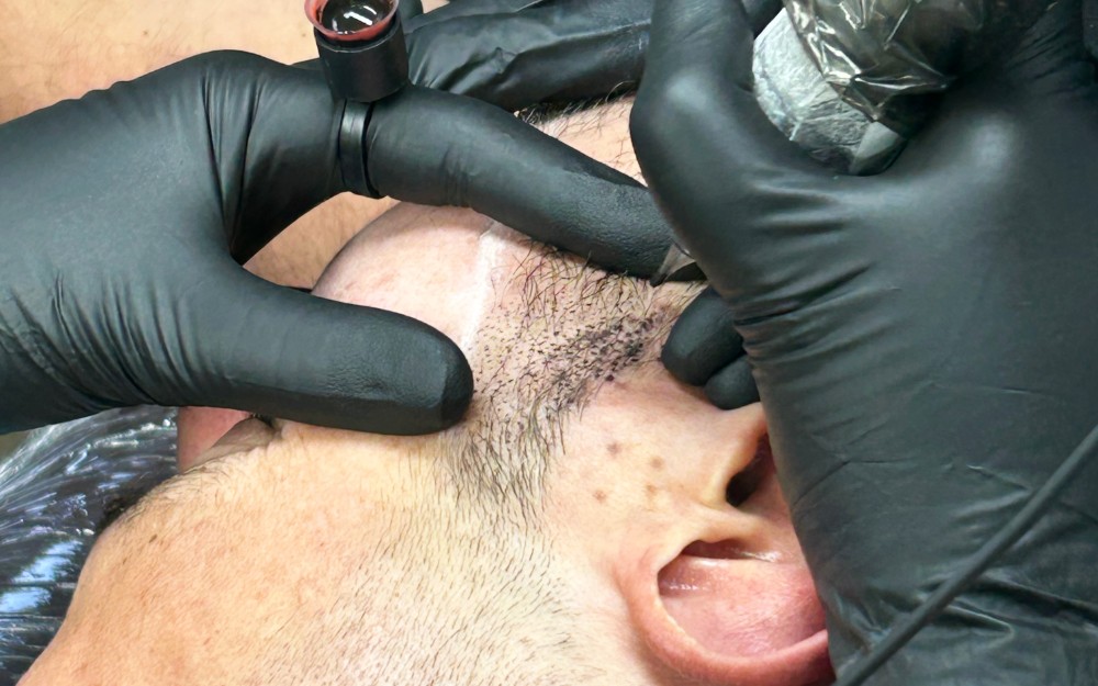 Tricopigmentation en cours de la barbe - homme - Centre Jennifer Glomaud