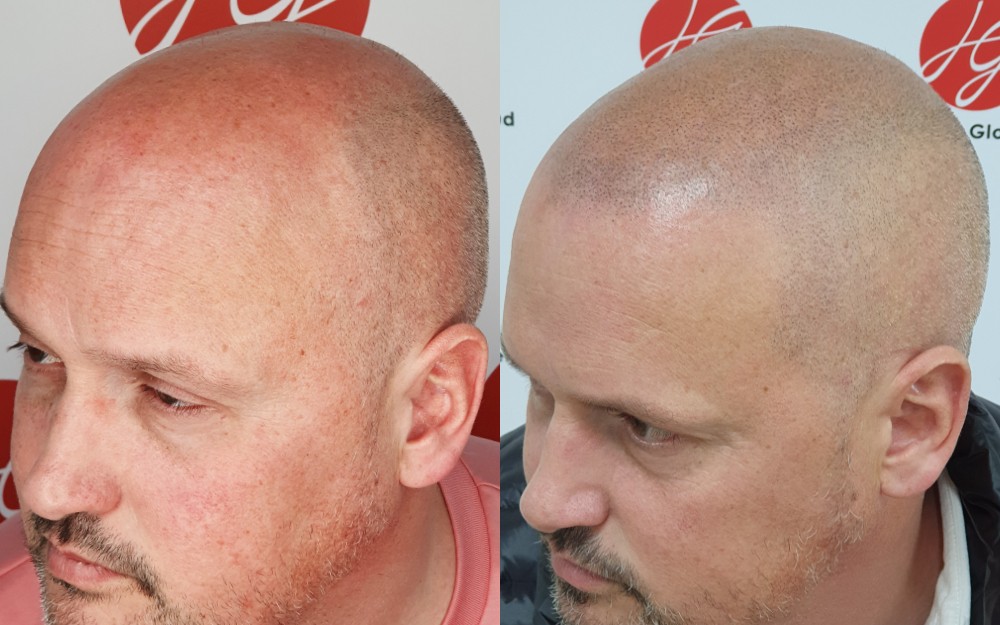 Tricopigmentation homme effet rasé avant / après