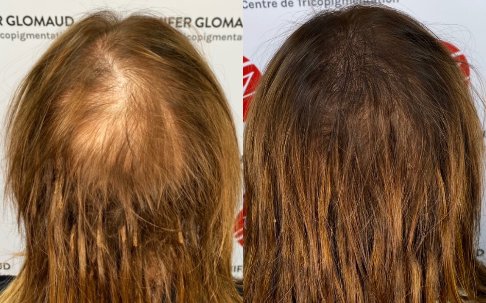 solution-ideale-tricopigmentation-femme